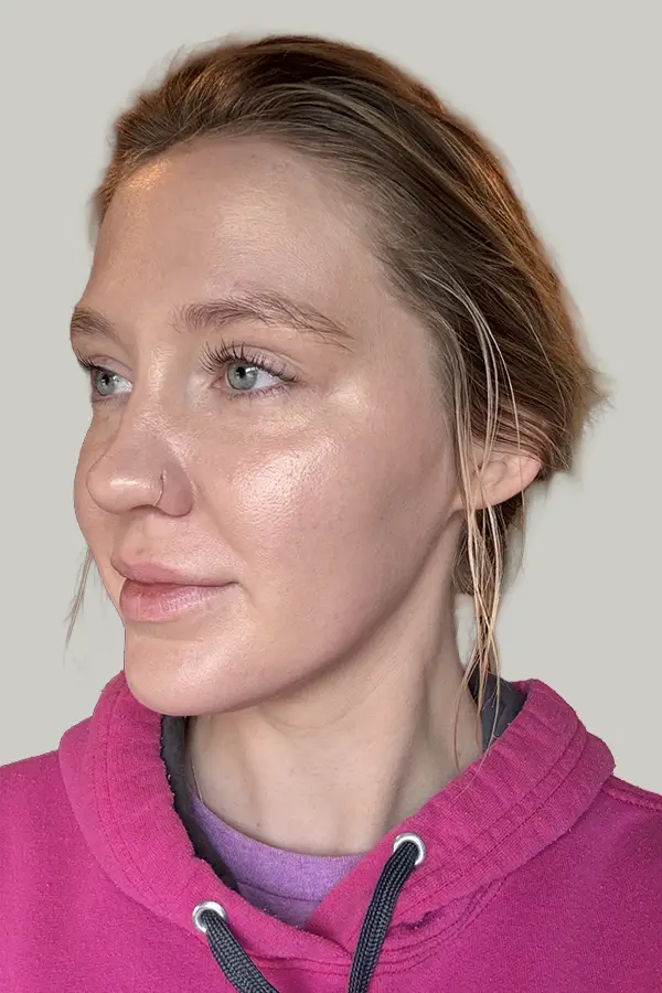 After microneedling and medical grade skincare by Meredith Tucker LE at CAMI — smoother skin texture with reduced acne scarring