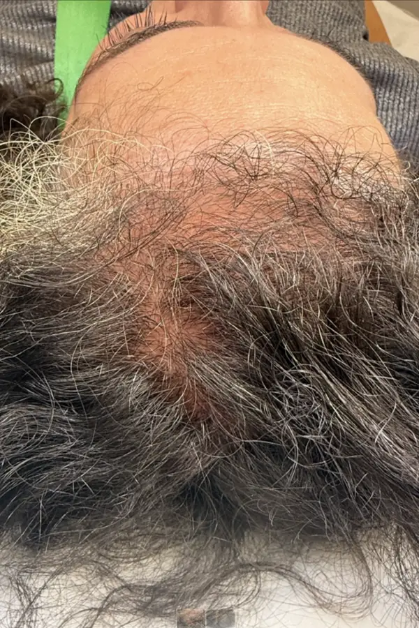 Before hair loss treatment at CAMI — visible thinning and reduced hair density at the scalp