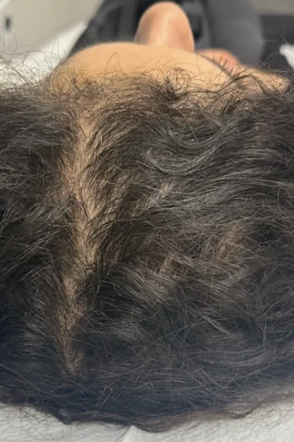 After hair loss treatment by Meredith Tucker LE at CAMI — improved hair density and hairline fullness