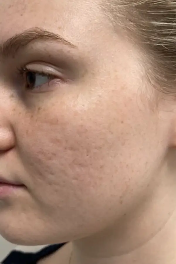 Before acne and microneedling treatment at CAMI — active breakouts and uneven skin texture