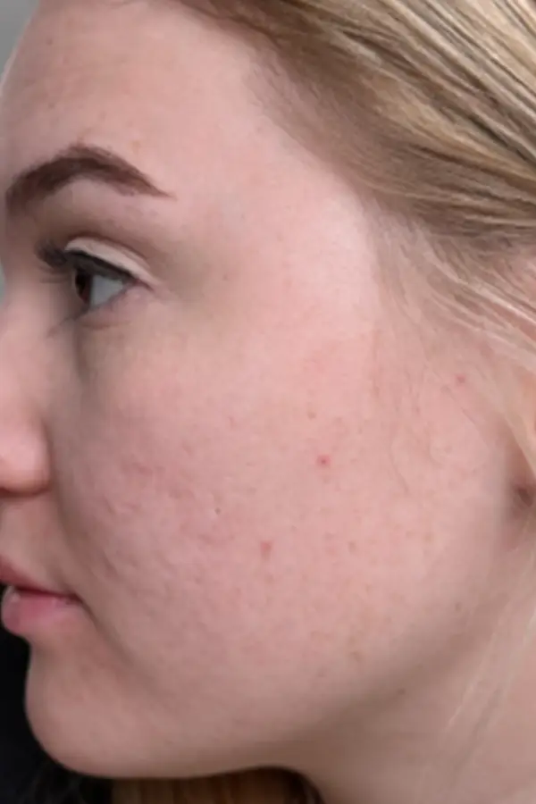 After microneedling, medical grade skincare, and acne treatment by Meredith Tucker LE at CAMI — clearer skin with reduced acne and improved texture