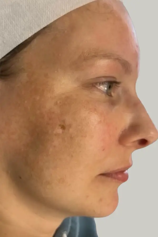 Before chemical peel at CAMI — uneven skin tone and surface texture irregularities