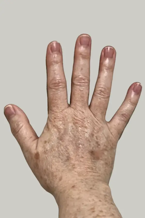 After BBL photofacial by Meredith Tucker LE at CAMI — improved sun damage and skin tone on hands