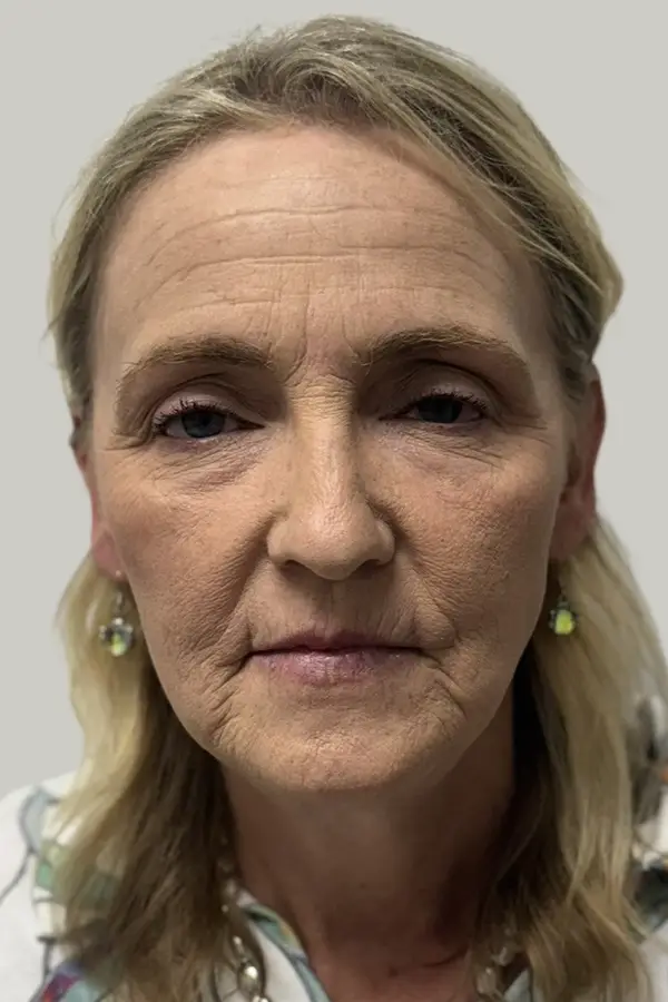 Before full face rejuvenation at CAMI — visible volume loss, hollow under eyes, and expression lines at rest