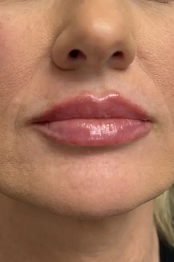After lip filler by Ashley Roberts RN at CAMI — improved lip volume and shape