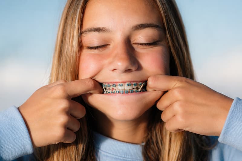 Teen stretching their cheeks to show braces with elastics