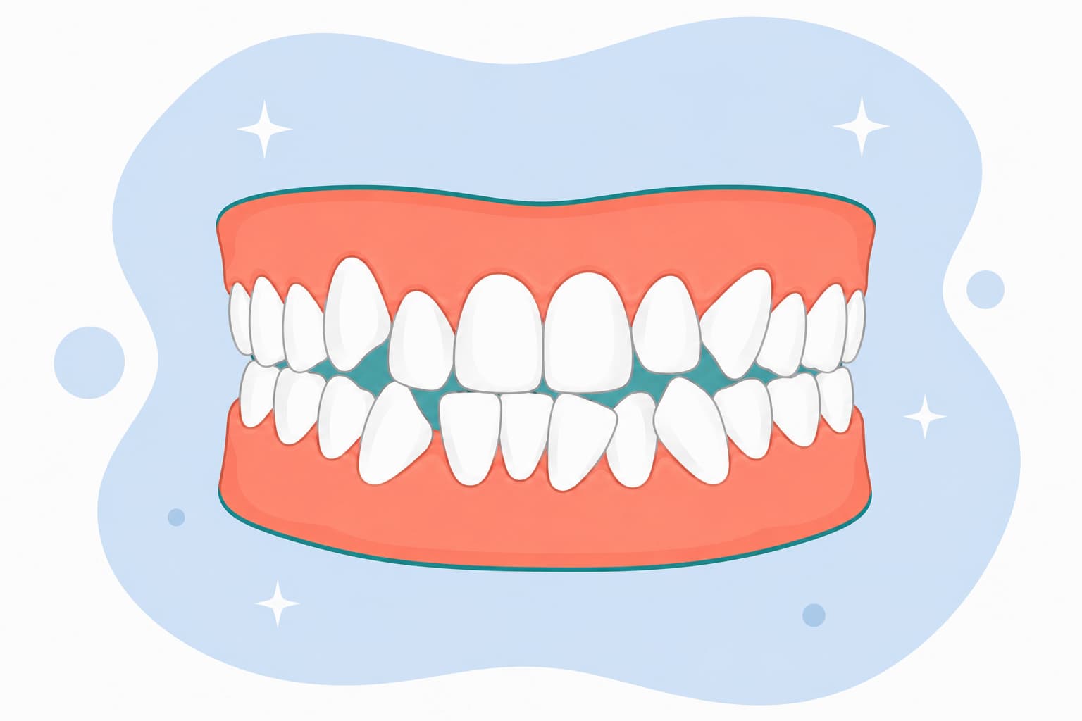 Illustration of teeth that are misaligned and crooked