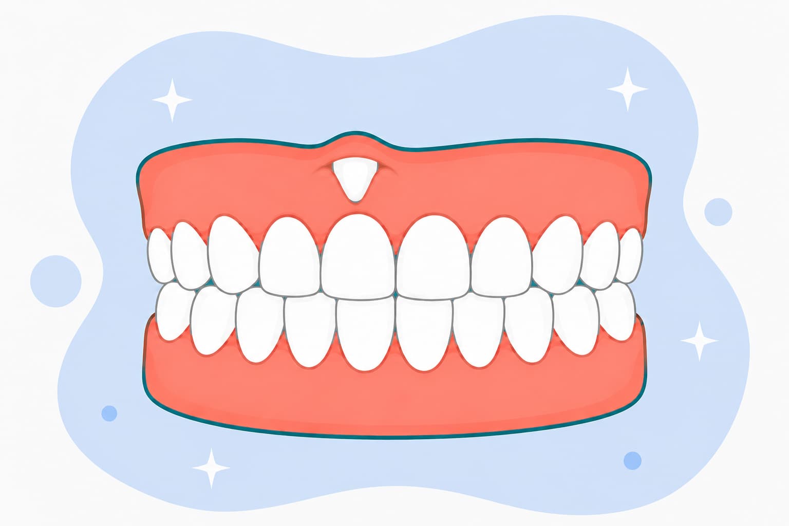 Illustration of a tooth erupting high out of the gum above the normal tooth line