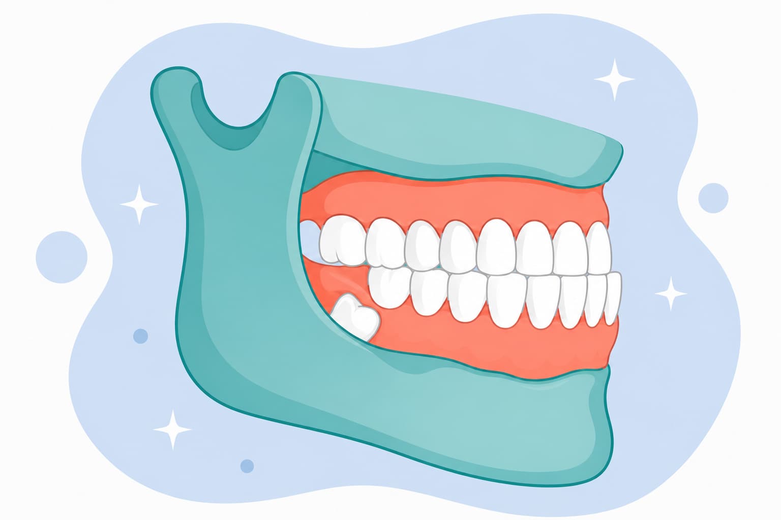 Side illustration of a jaw with a tooth trapped below the gumline, showing an impacted tooth