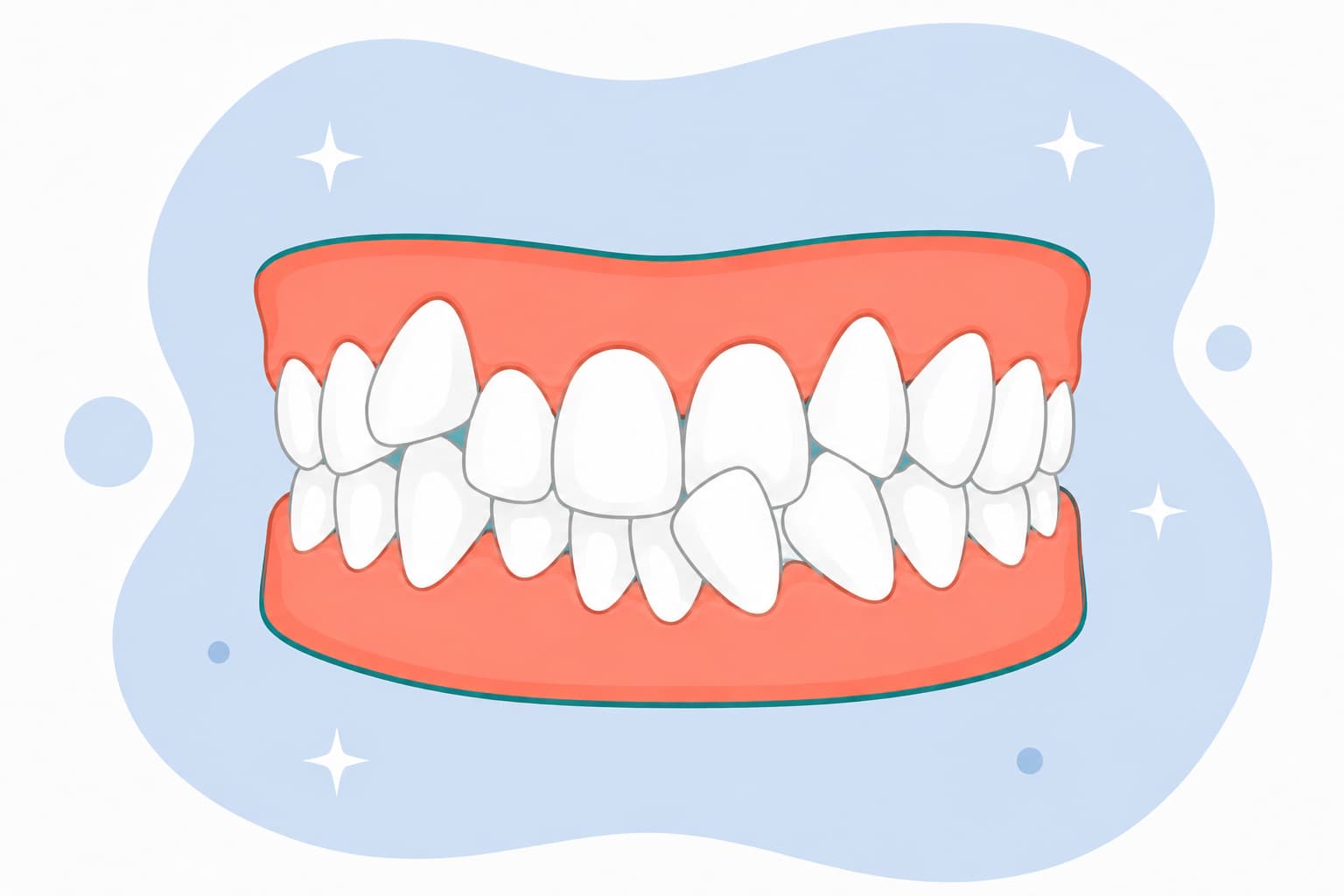Illustration of overlapping, crowded front teeth with too little space