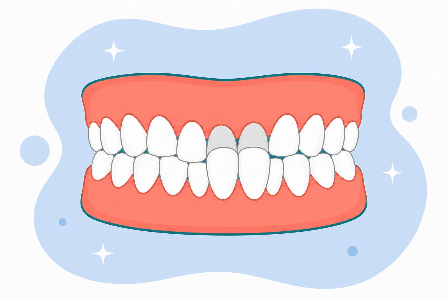 Illustration of teeth where an upper tooth bites inside the lower teeth, showing a crossbite