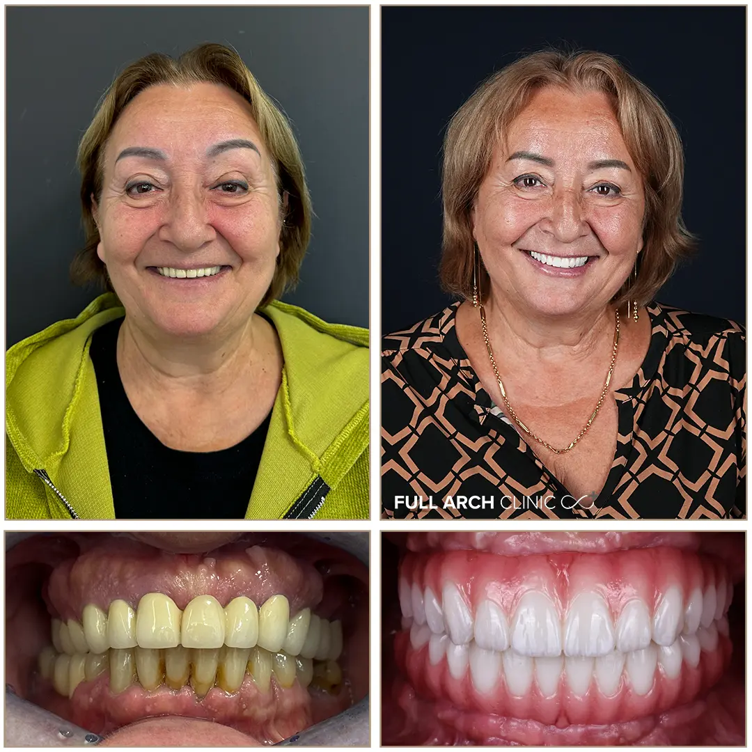 Pacienta cu zambet refacut pe implanturi dentare - Dr. Andrei Stan