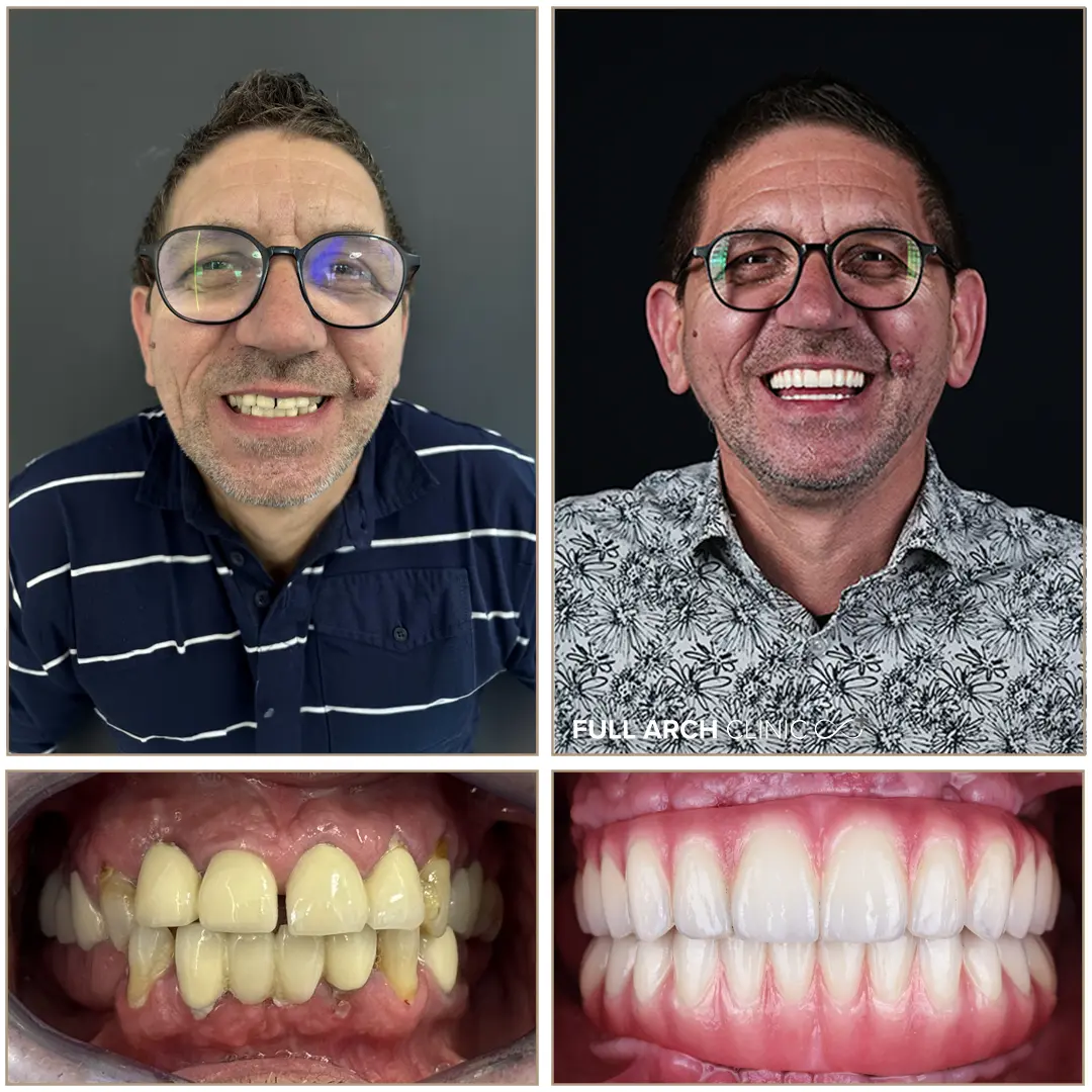 Pacient cu reabilitare orala completa - Dr. Andrei Stan