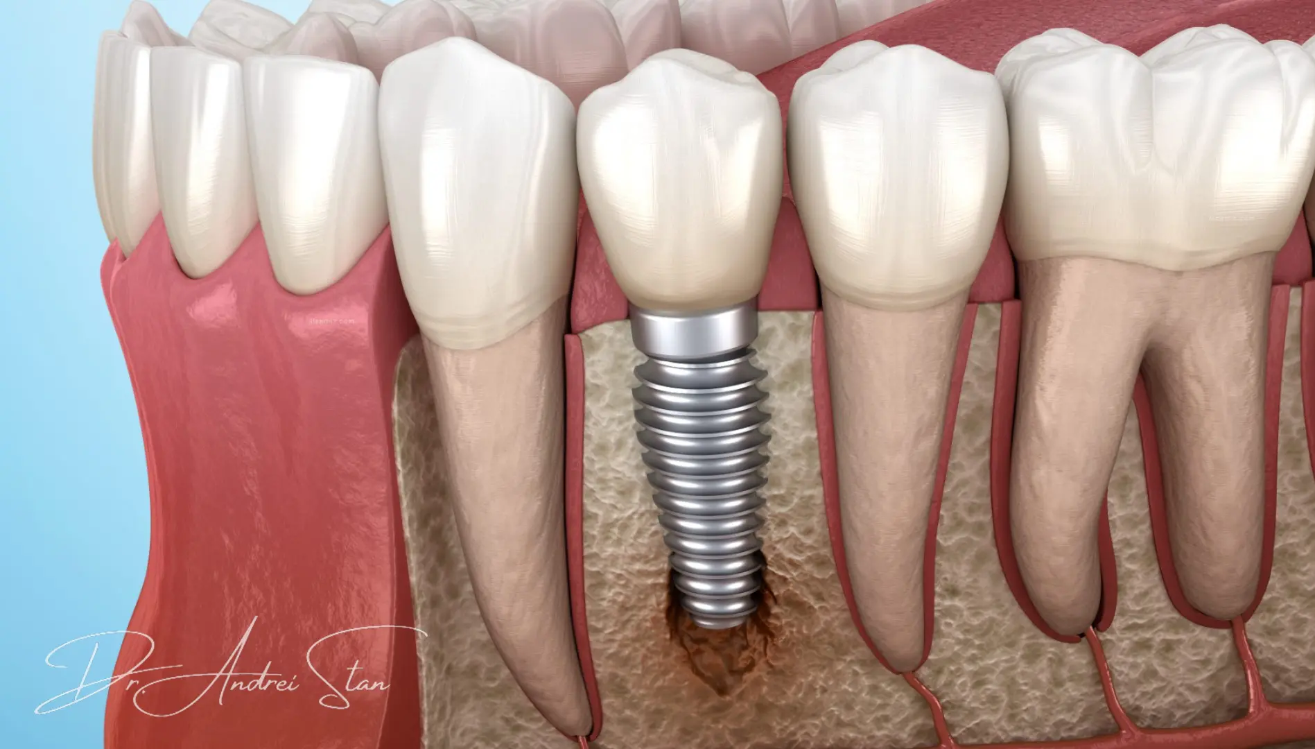 Simptome de respingere a implantului dentar - semne de eșec al osteointegrării și soluții