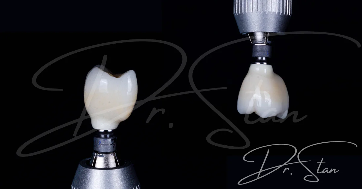Coroană pe implant dentar - tipuri de coroane dentare și prețul lucrării pe implant
