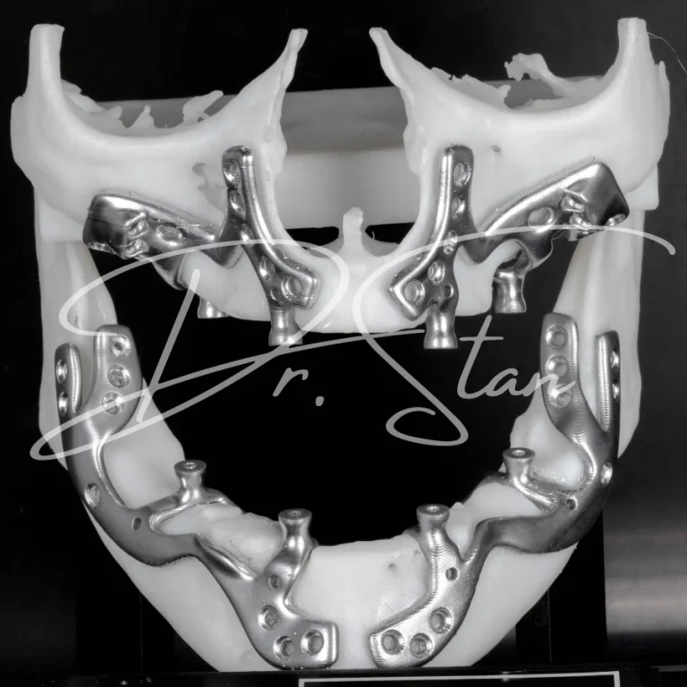 Implant subperiostal - tratament, etapele procedurii și prețul pentru atrofie osoasă severă