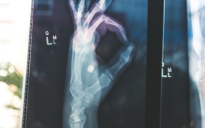X-ray image of a human hand
