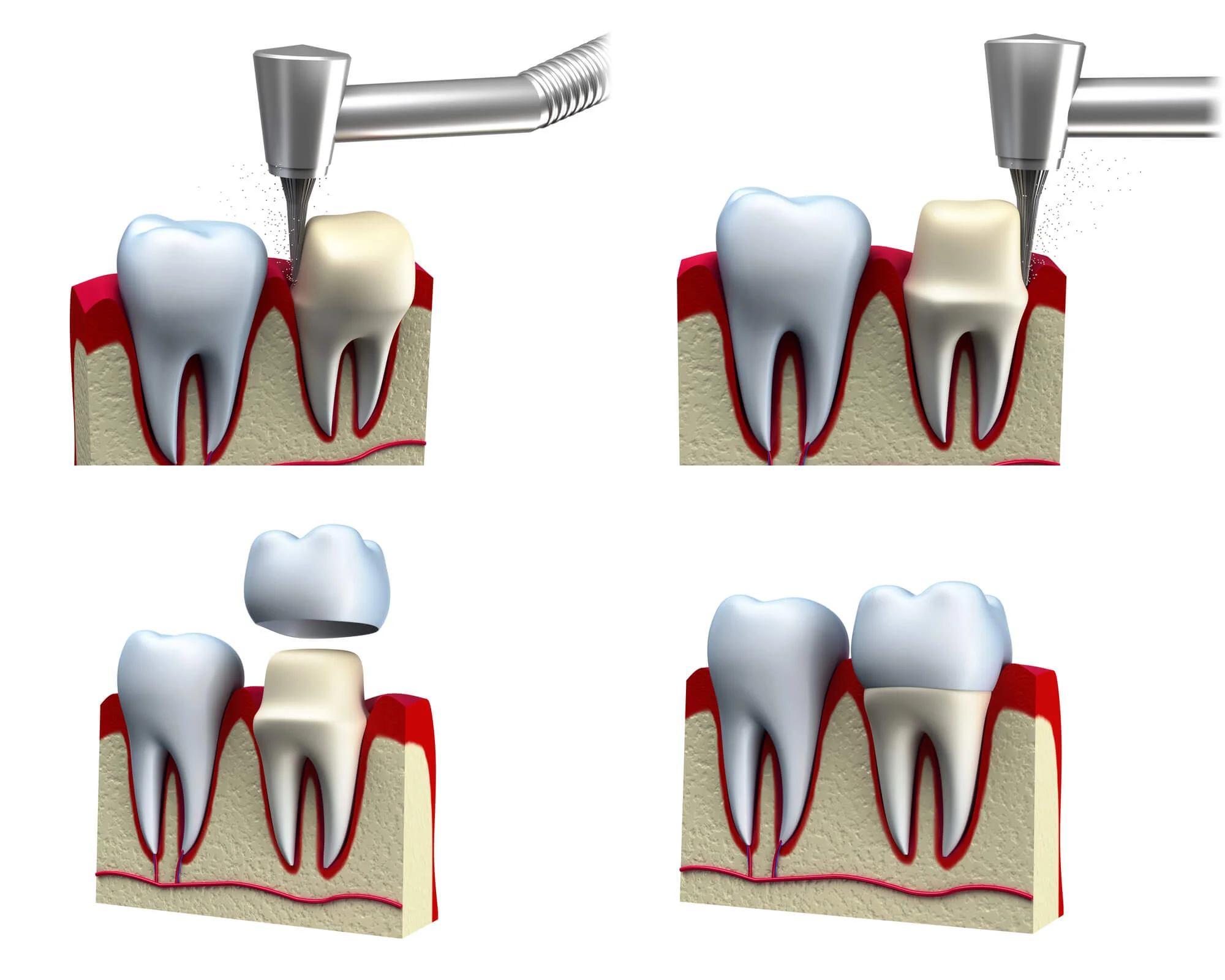 Four-step illustration showing dental crown installation: tooth being trimmed, shaped, crown placement, and final restored tooth.