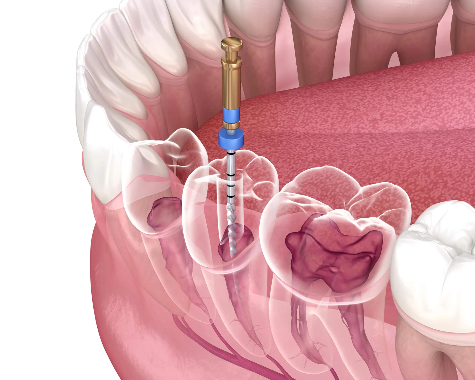 3D illustration showing a dental file inserted into a tooth root canal for treatment.