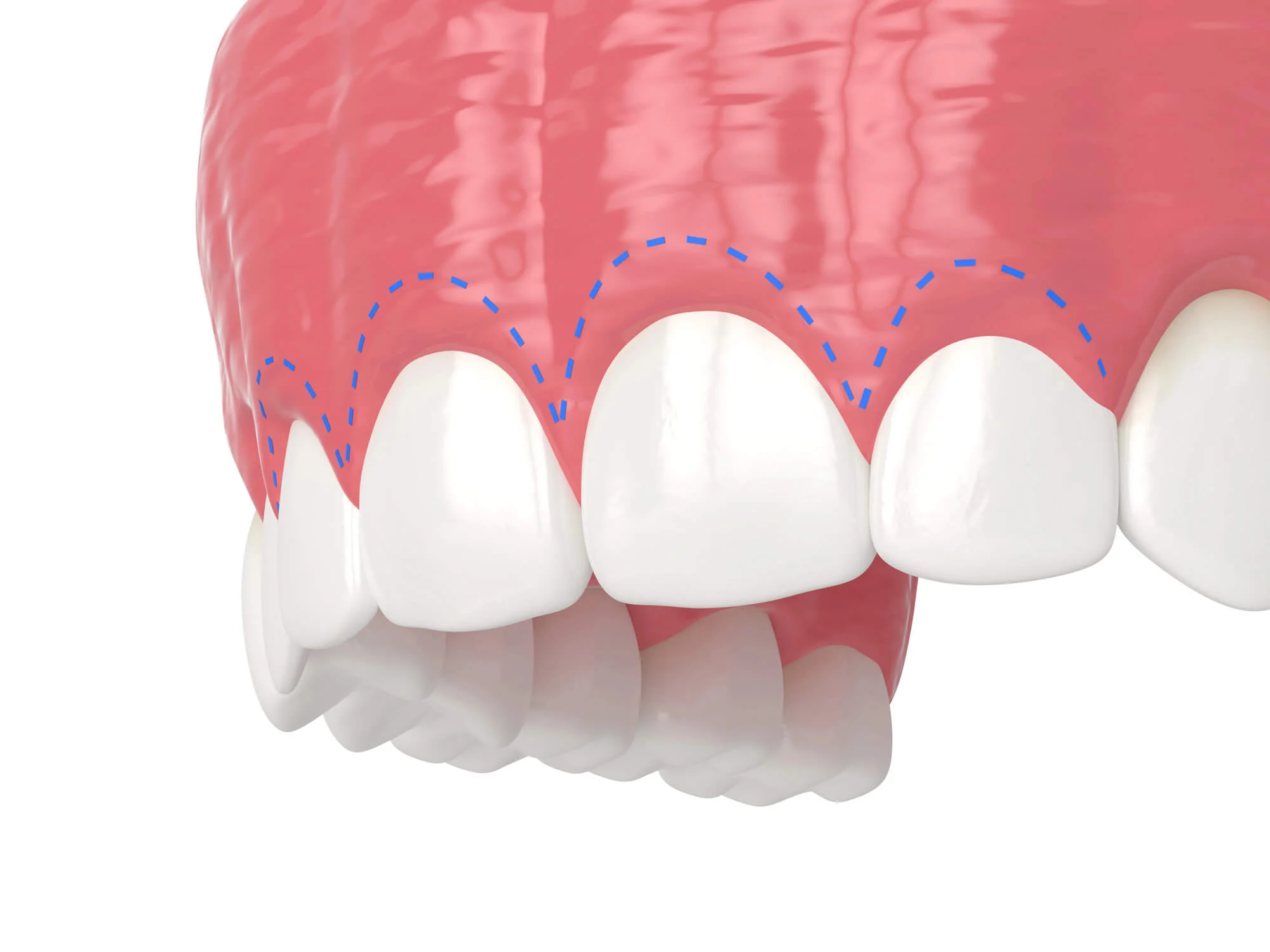 Close-up of upper front teeth and gums with a blue dotted line indicating gum contour.