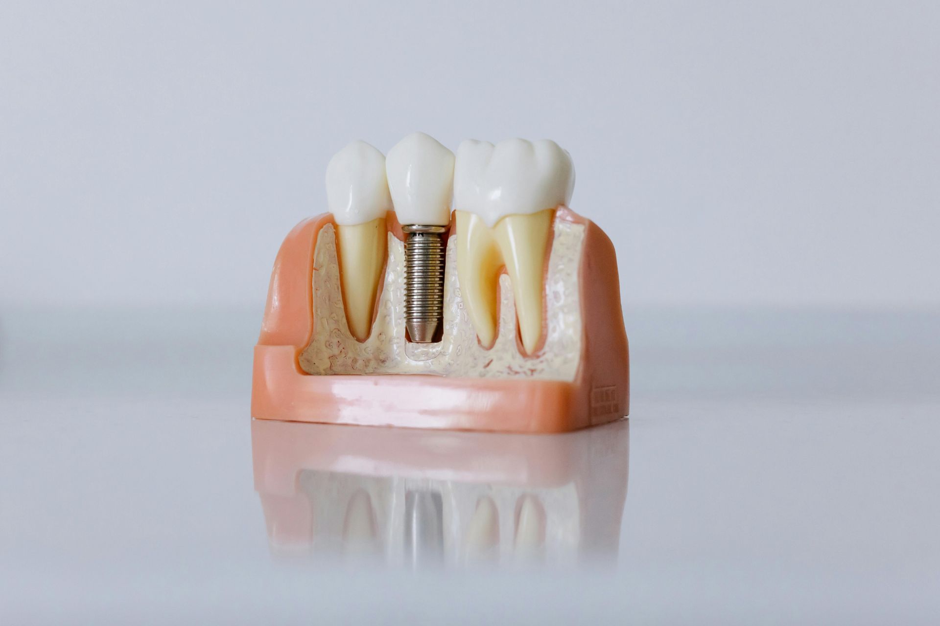 Dental model showing three teeth, including one with a metal dental implant in the jawbone.