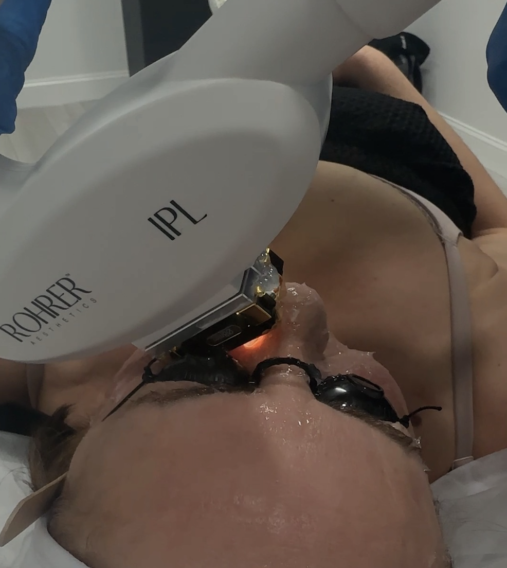 IPL Photofacial (Photo Rejuvenation)