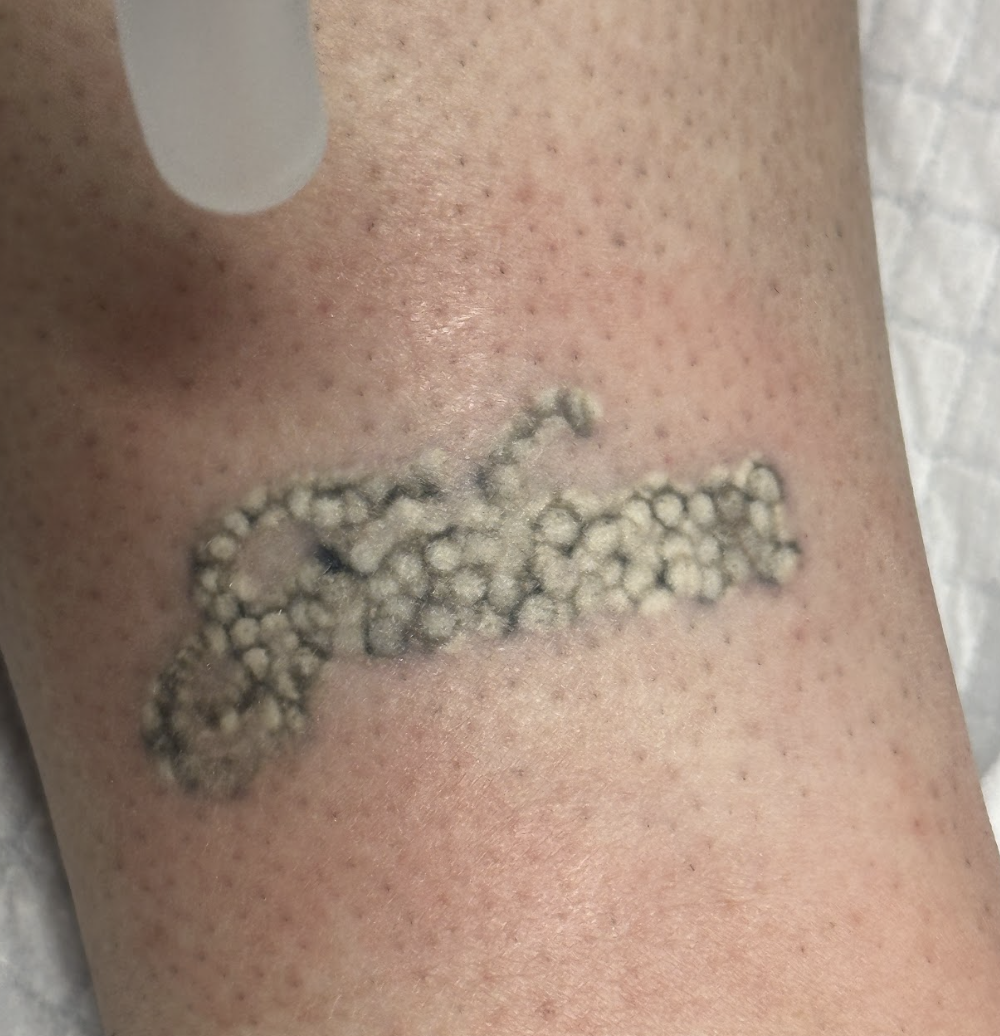 Tattoo Removal