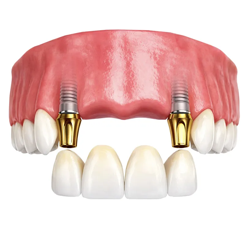 Multi-Implant Dental Bridge
