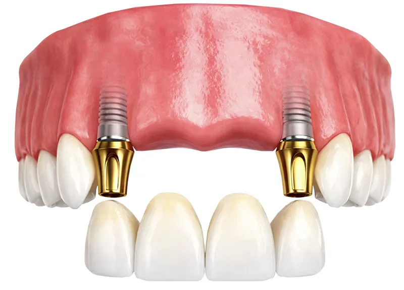 Multiple Implant Supported Bridge