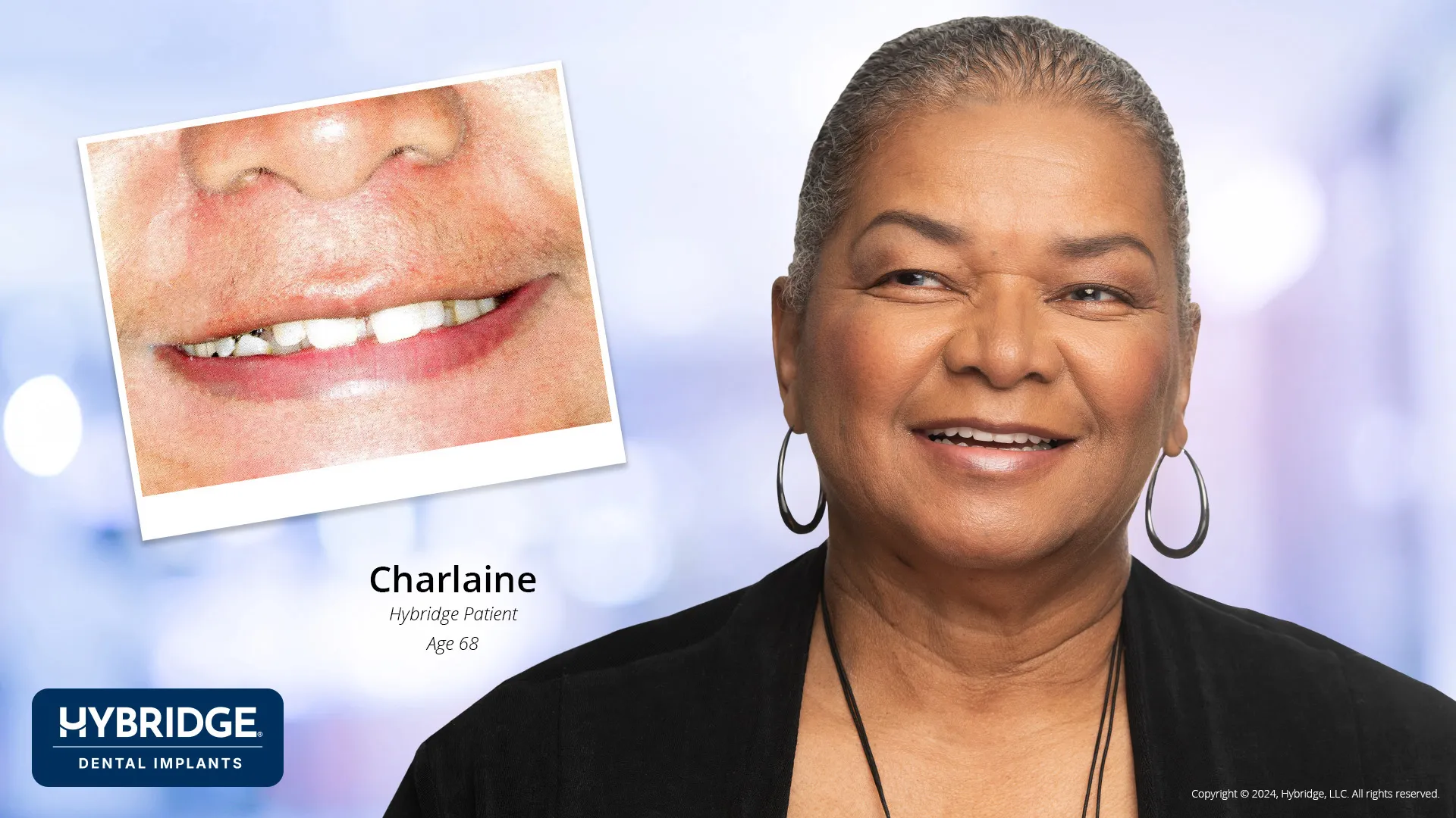 Actual Hybridge Patient - Charlaine