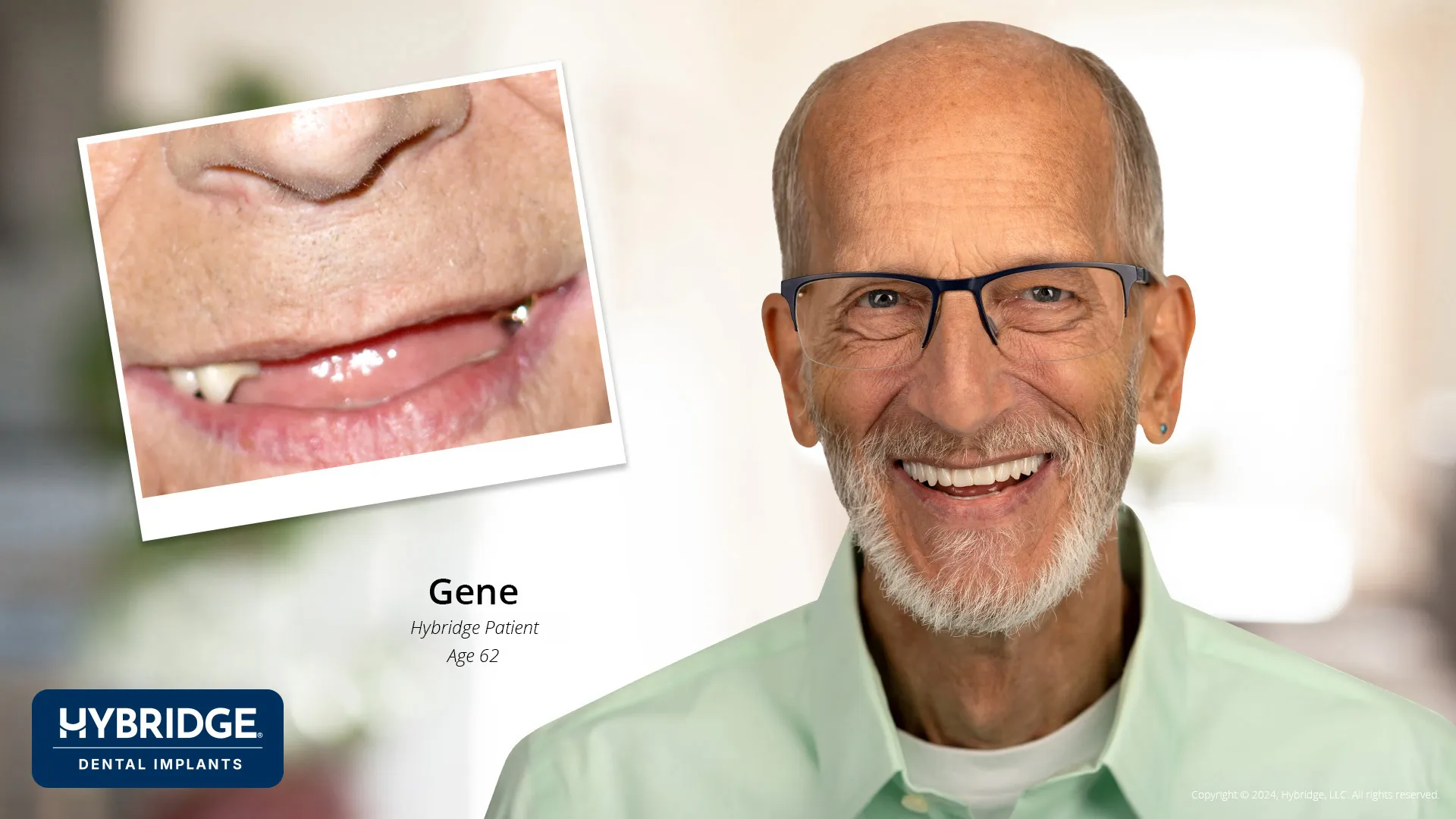 Gene Before & After