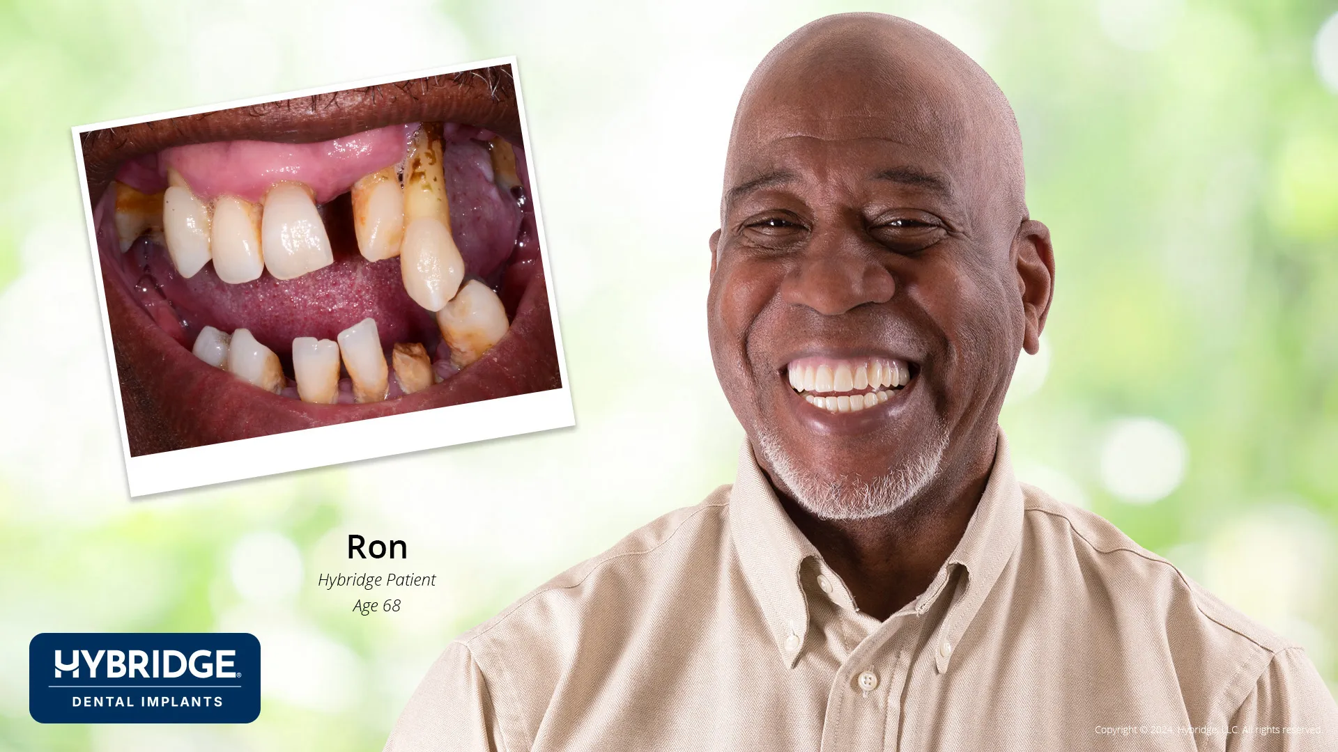 Actual Hybridge Patient - Ron