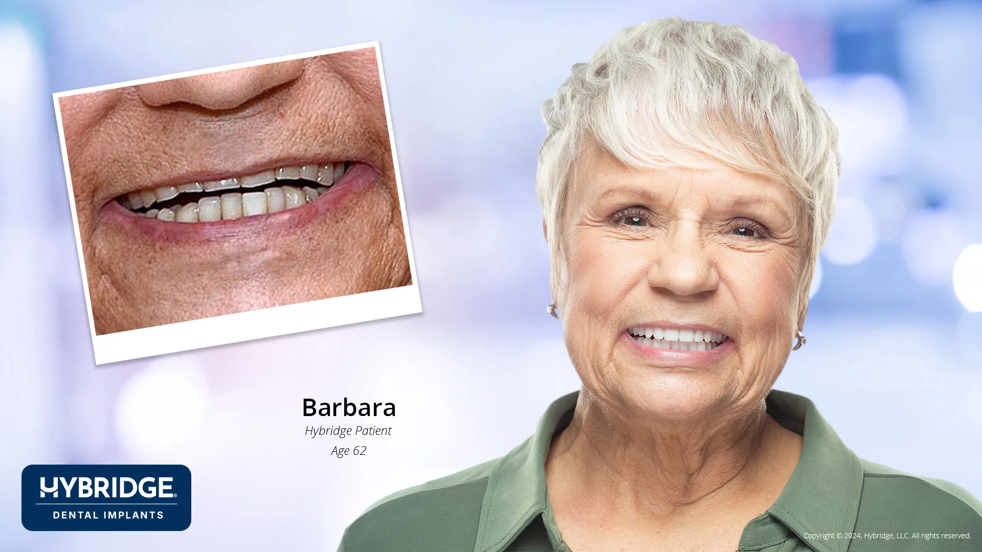 Barbara Before & After