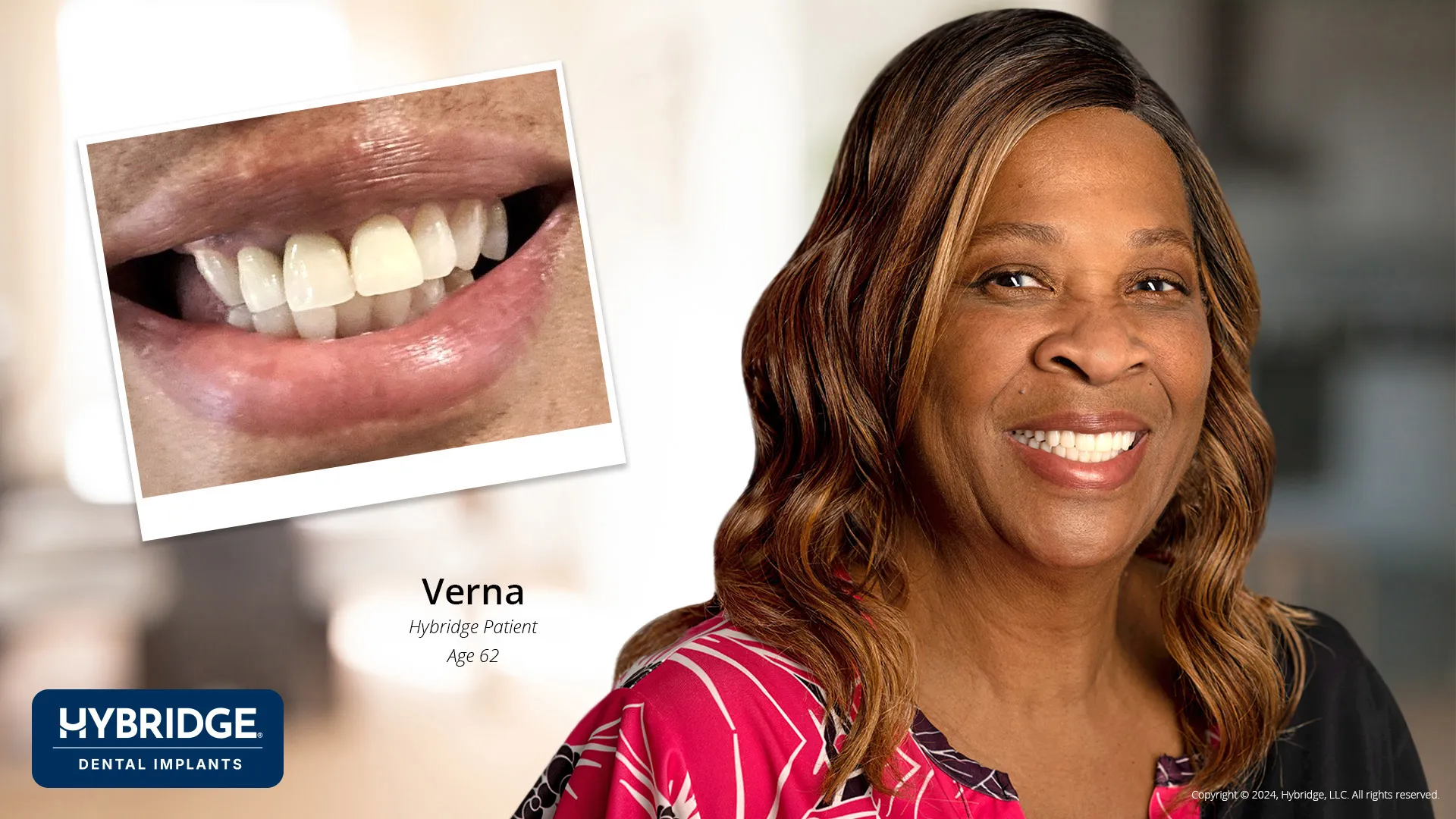 Verna Before & After