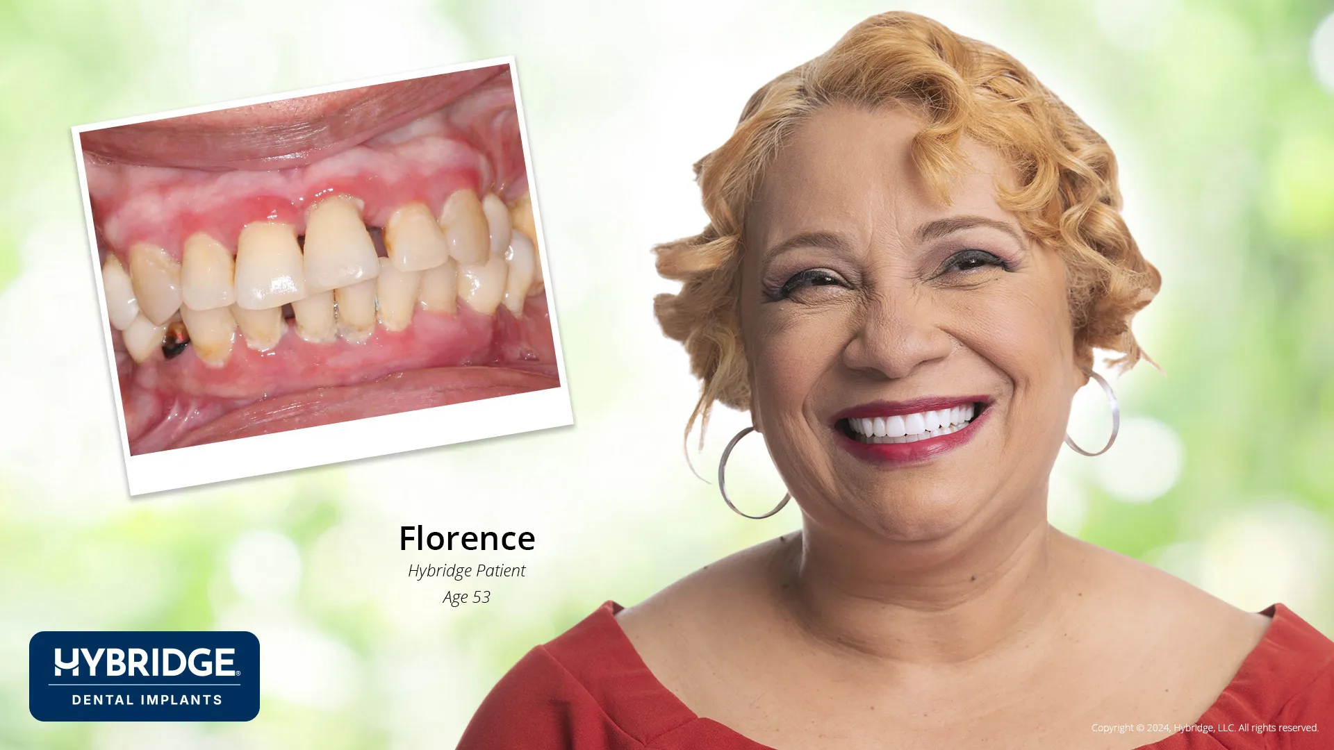Actual Hybridge Patient - Florence