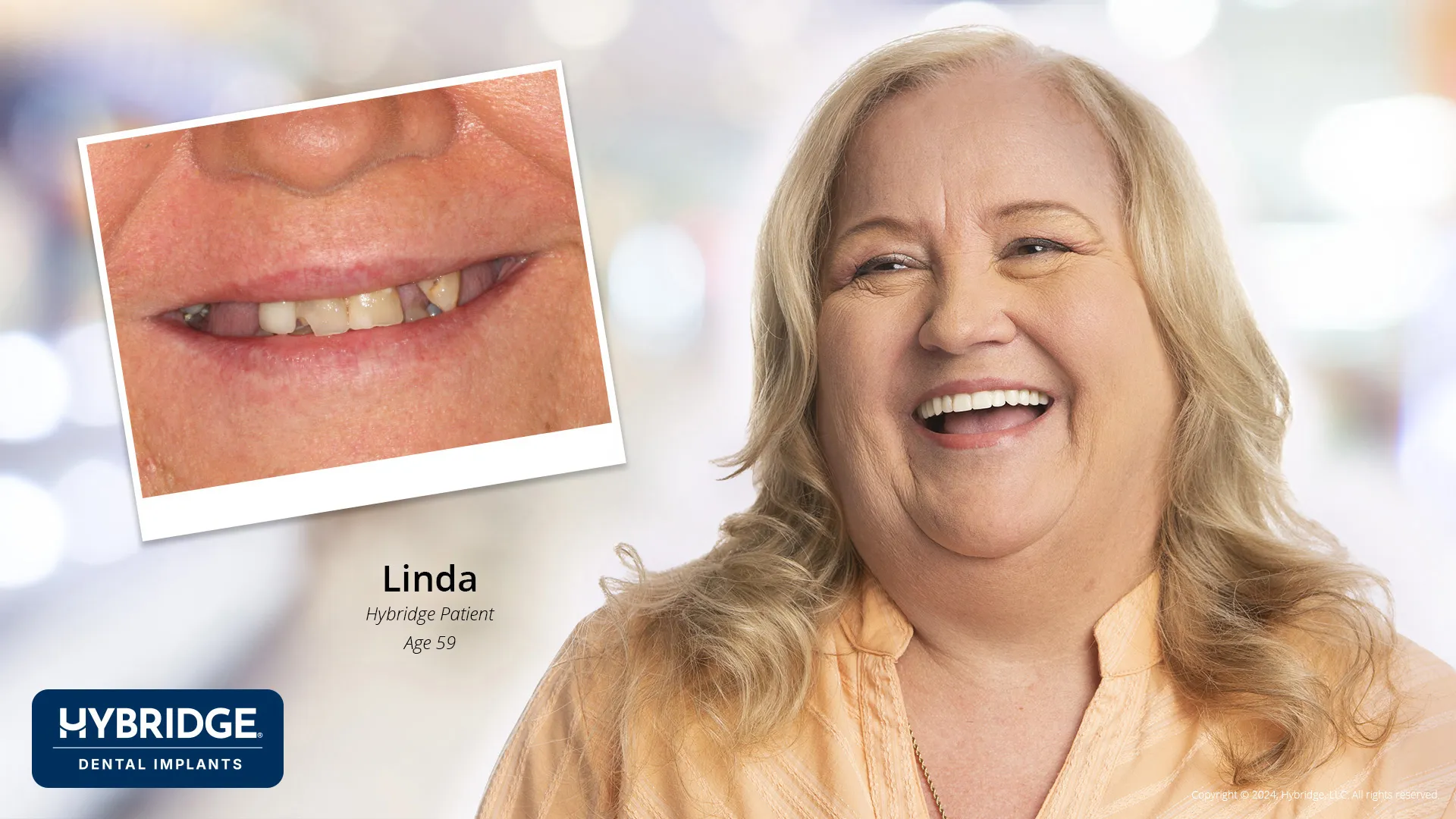 Actual Hybridge Patient - Linda