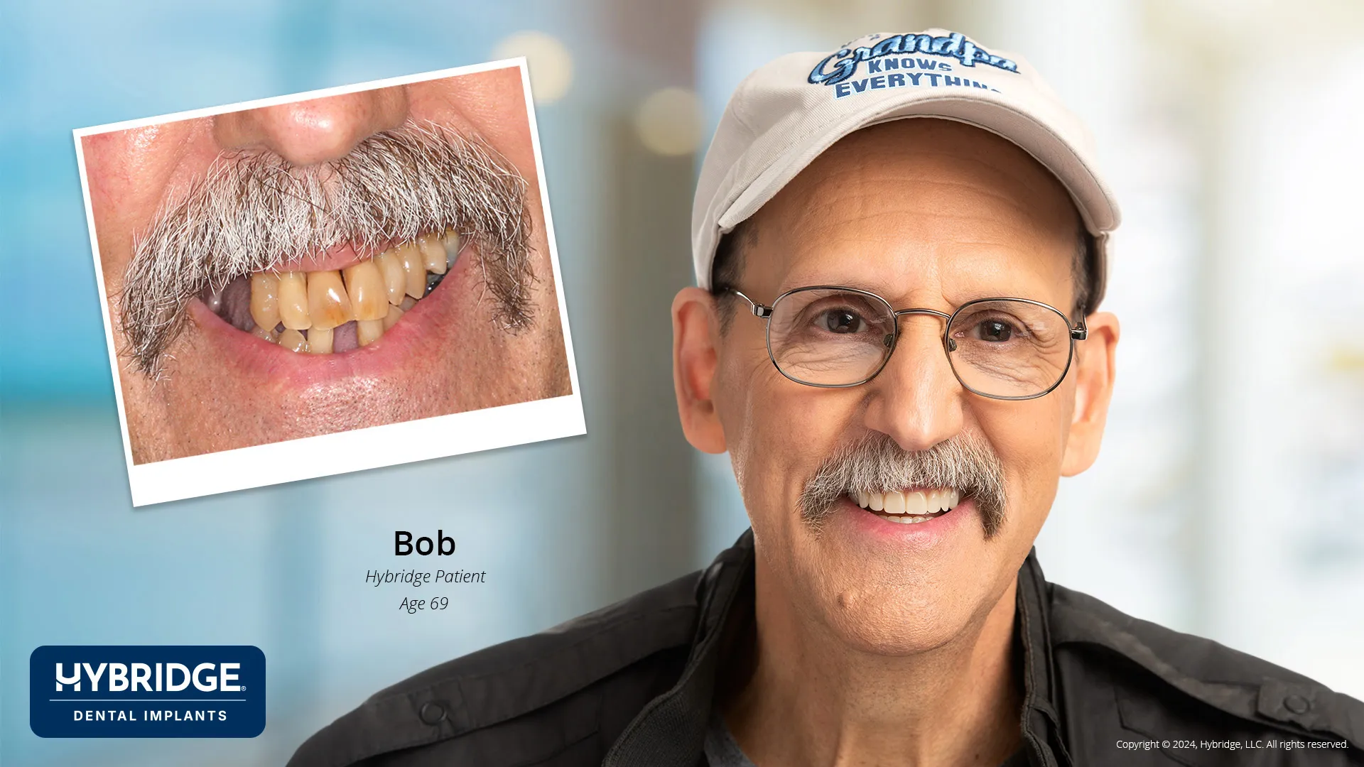 Actual Hybridge Patient - Bob