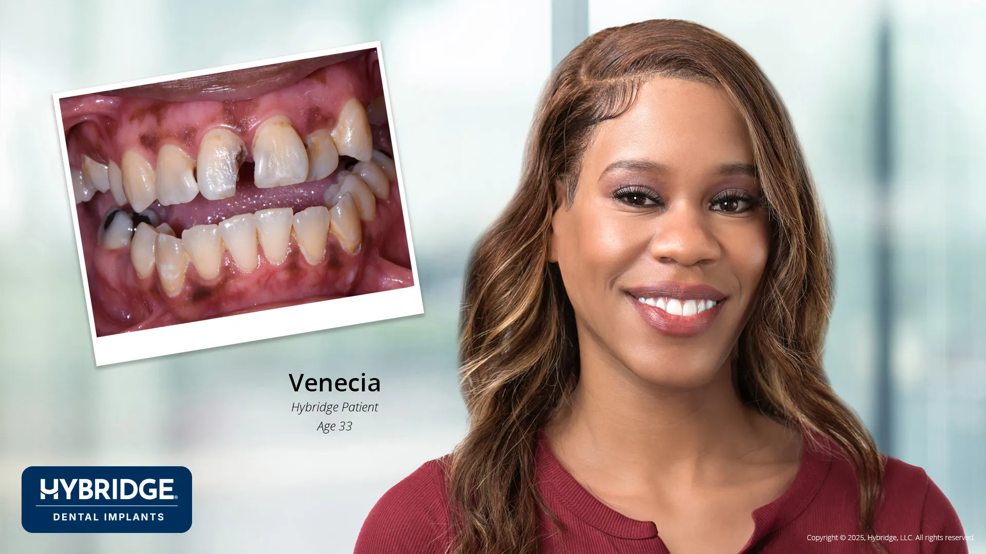 Actual Hybridge Patient - Venecia