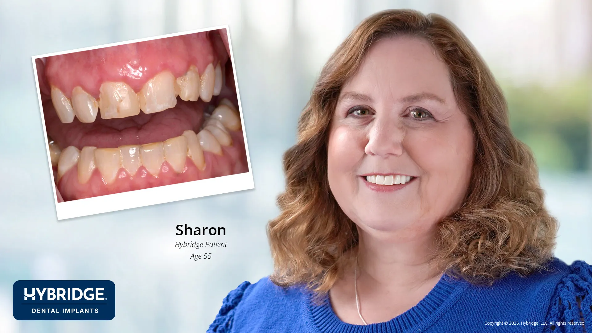 Actual Hybridge Patient - Sharon