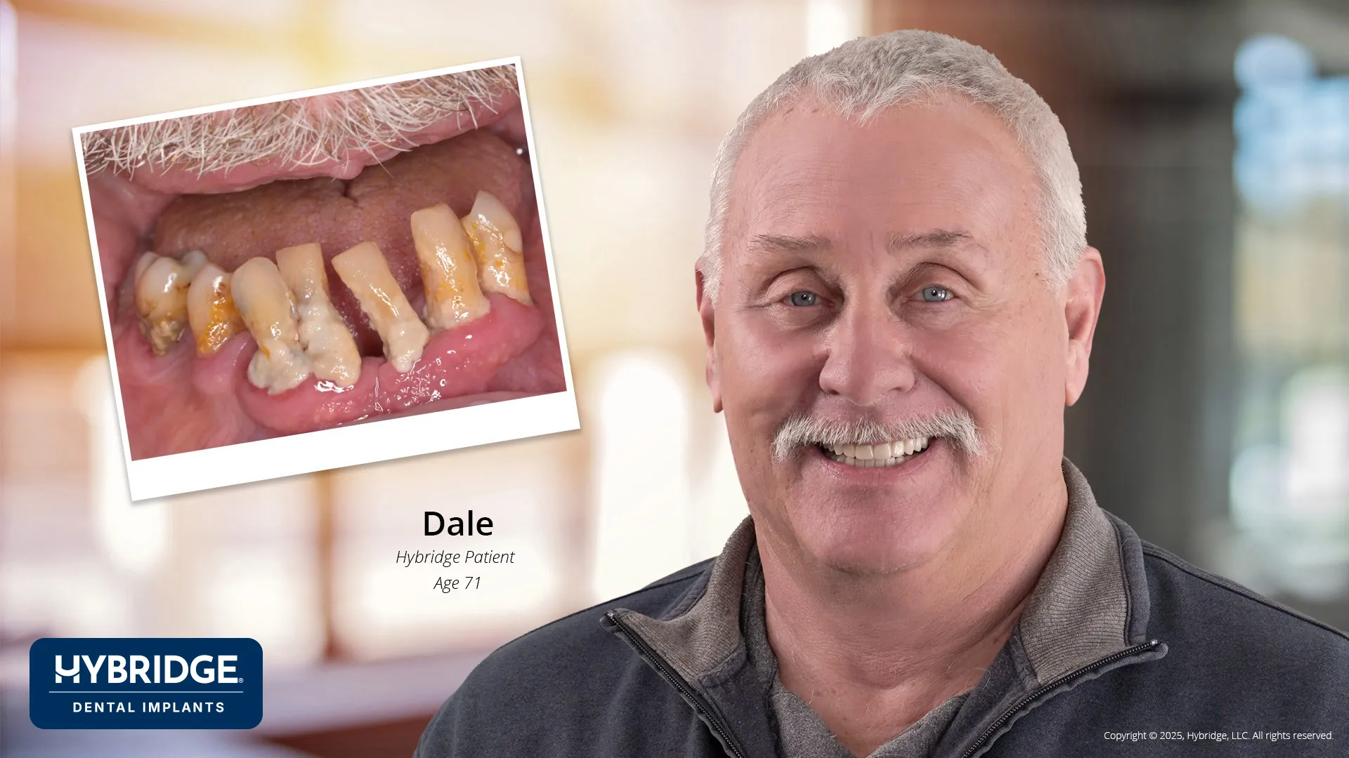 Actual Hybridge Patient - Dale