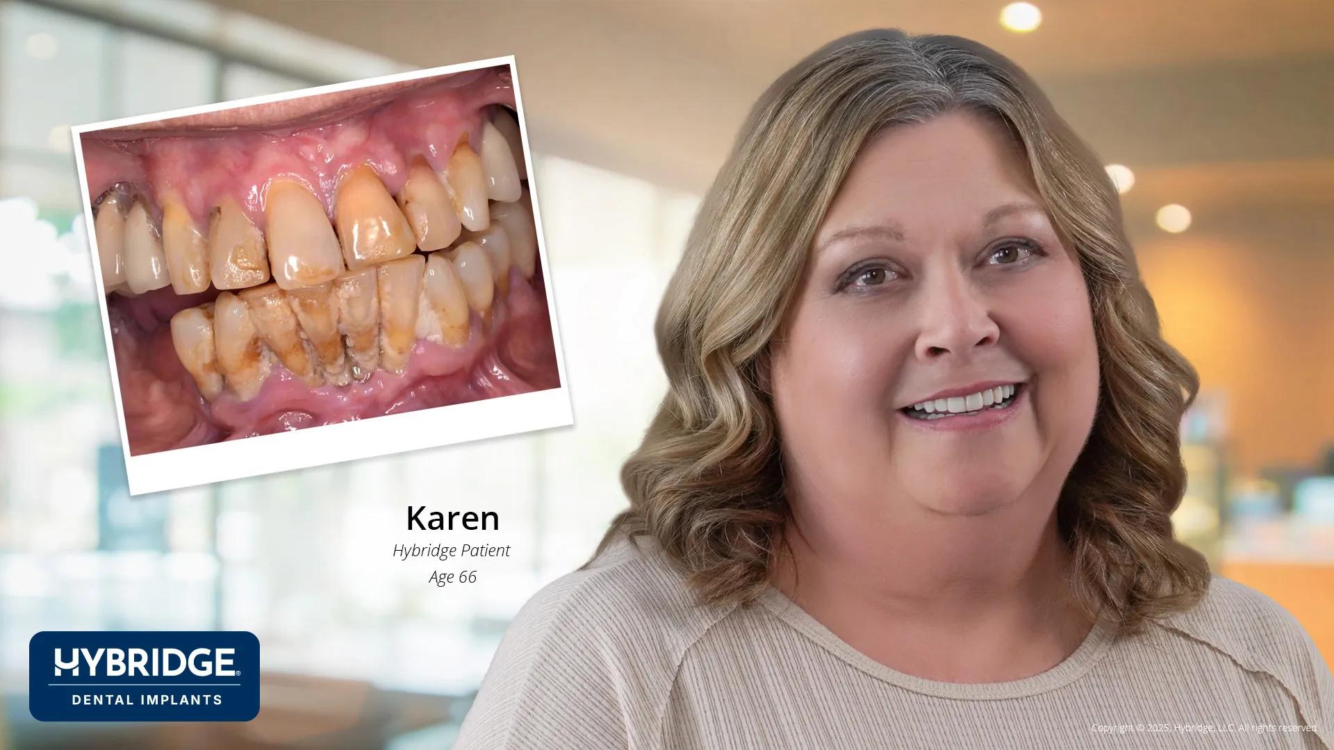 Actual Hybridge Patient - Karen