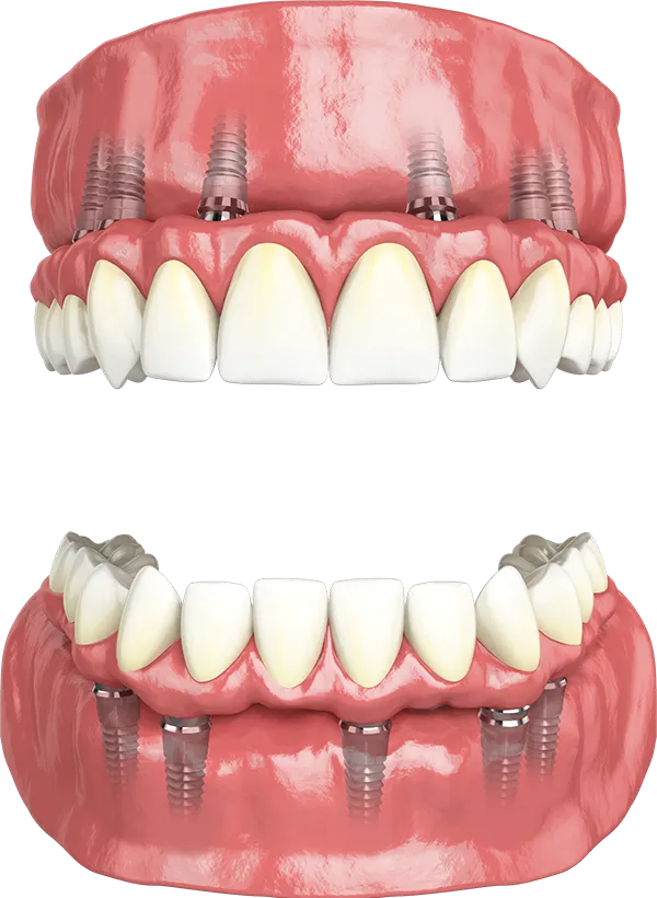 Hybridge Upper and Lower Full-Arch