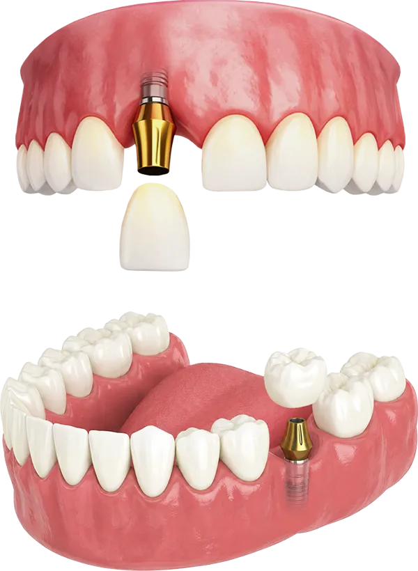 Upper and Lower Single Dental Implants