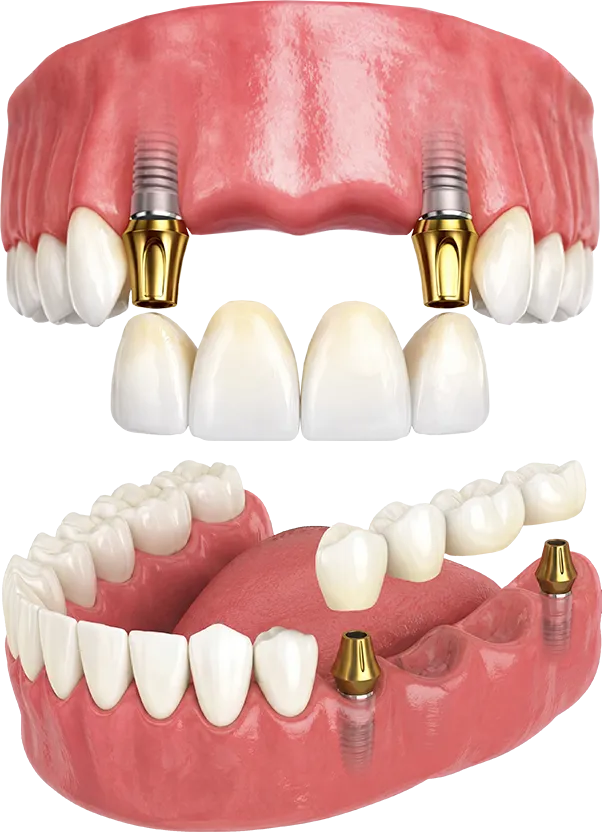 Upper and Lower Multi-Tooth Dental Implant Bridge