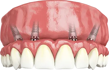Dental model showing four implants supporting an upper denture with natural teeth in front.