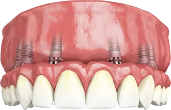 Dental model showing upper jaw with four metal implants inserted into the gums above teeth.
