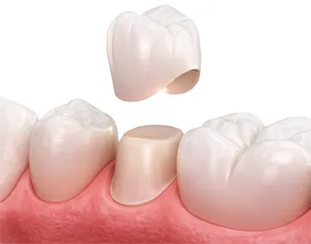 Dental crown being placed over a prepared tooth among natural teeth and gums.