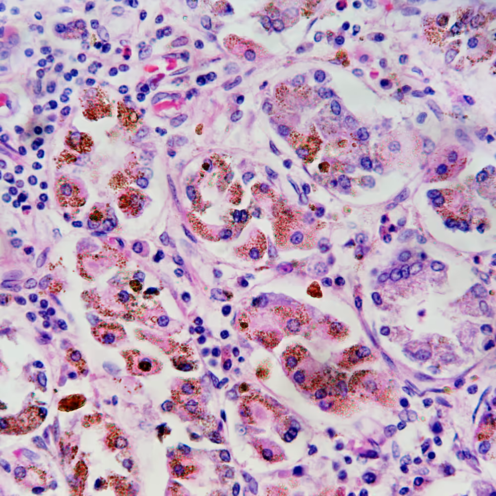 Microscopic image of liver tissue showing iron deposits characteristic of hereditary haemochromatosis.