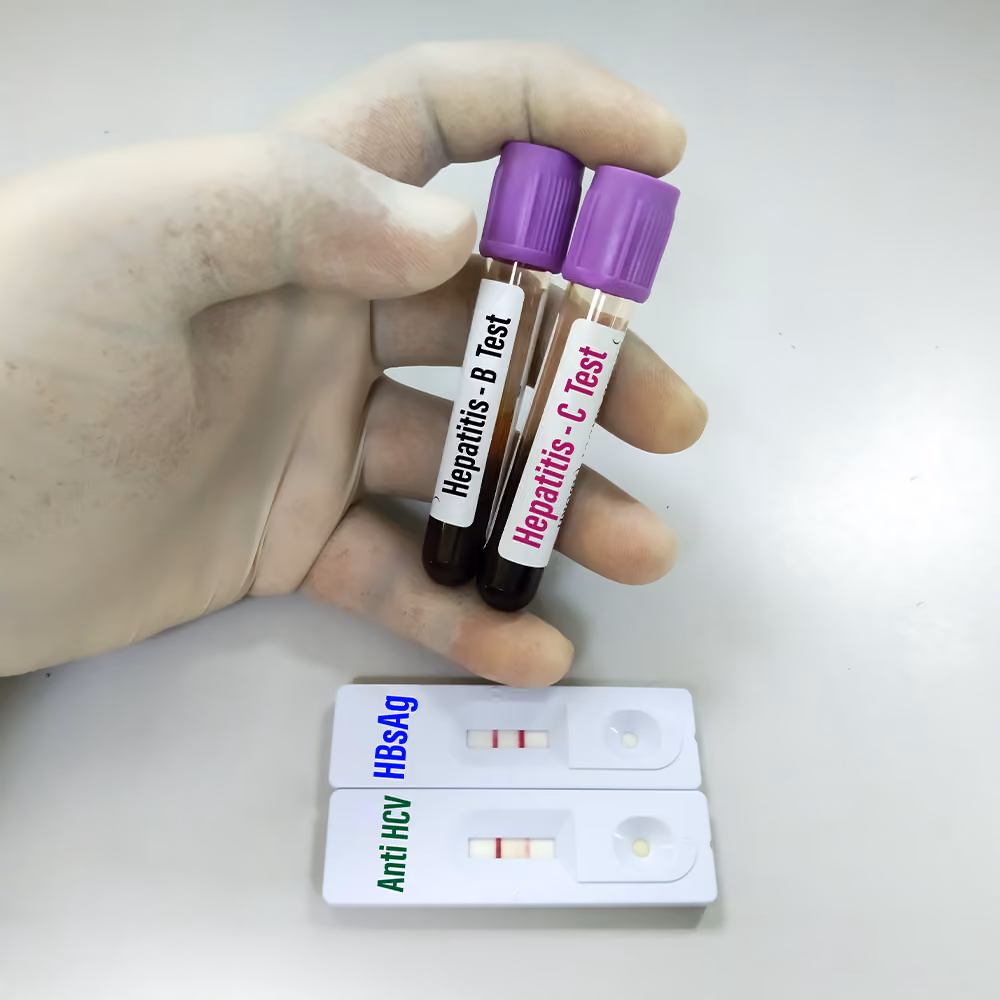 Blood samples and rapid test cassettes used to screen for hepatitis B and hepatitis C infections in a clinical laboratory setting.