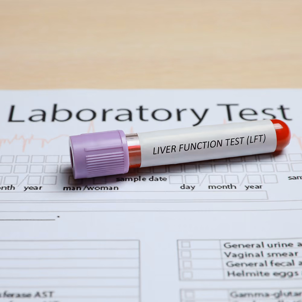 Blood sample tube for a liver function test (LFT) placed on a laboratory request form to assess cholestatic liver disease and liver health.